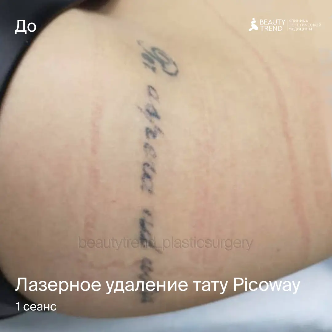 Удаление тату Picoway, 2С - до 1